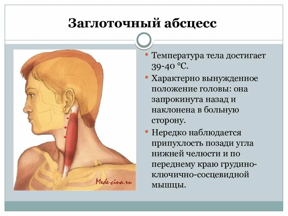 Заглоточныйзаглоточный абсцесс. Заднеглотояный абсцесс. Ретрофарингеальный абсцесс. Проявленной одной из сторон