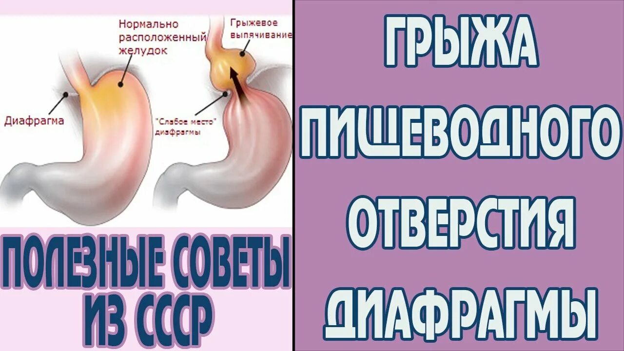 Грыжа пищевода упражнения. Упражнения при грыже пищеводного отверстия. Диета при грыже пищеводного отверстия. Упражнения при грыже пищеводного отверстия диафрагмы.