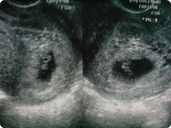 Многоплодная беременность УЗИ 6 недель. УЗИ беременность 6 недель однояйцевые Близнецы. УЗИ на 7 неделе беременности Близнецы. УЗИ 7 недель беременности двойня. Двойня 7 недель