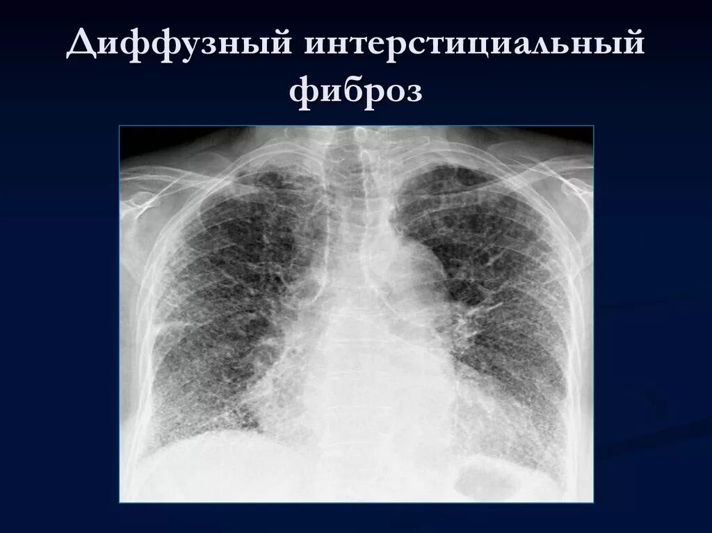 Умеренные фиброзные изменения. Посттуберкулезный пневмофиброз. Диффузный интерстициальный фиброз. Интерстициальный легочный фиброз рентген. Диффузный интерстициальный пневмофиброз кт.