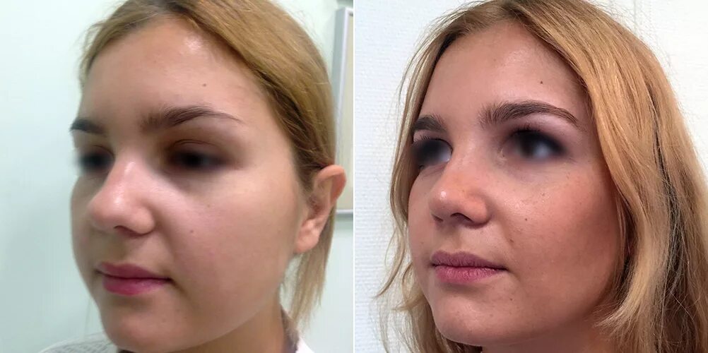 Операция носа отзывы