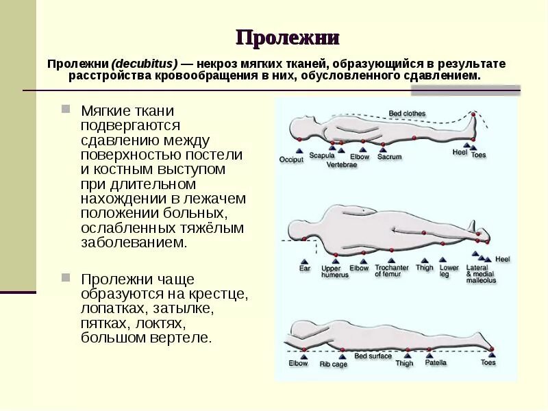 Чтобы не было пролежней у лежачего. Стадий развития пролежней. места образования пролежней у пациента. типичные места образования пролежней.