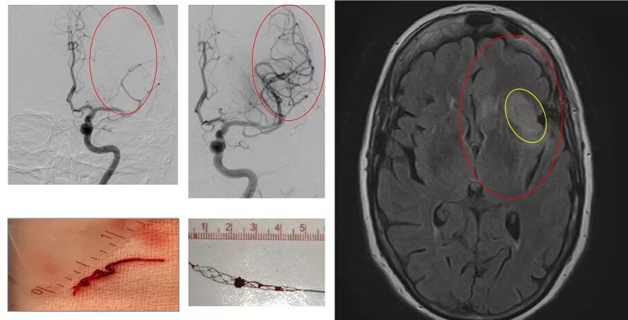 Тромб после инсульта. Эндоваскулярная тромбэкстракция. Тромболизис при инсульте. Тромбоэкстракция операция. Операция тромбоэкстракция при ишемическом инсульте.