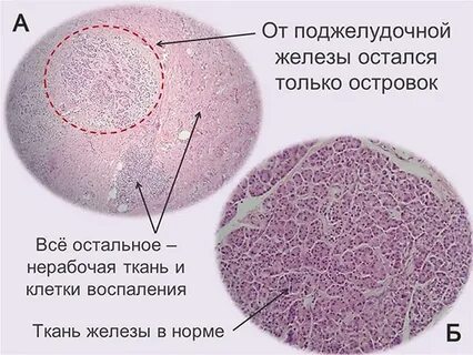 Антитела к островковым клеткам поджелудочной железы