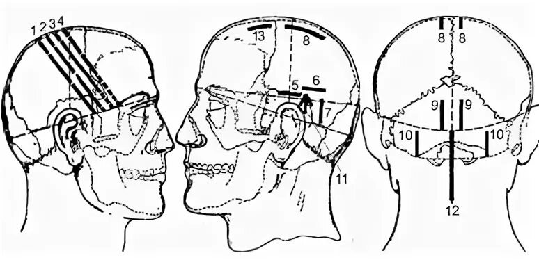 скальпотерапия зоны. скальп акупунктура. скальпотерапия зоны. какой автор предложил краниопунктуру скальптерапию. какой автор предложил краниопунктуру скальптерапию.