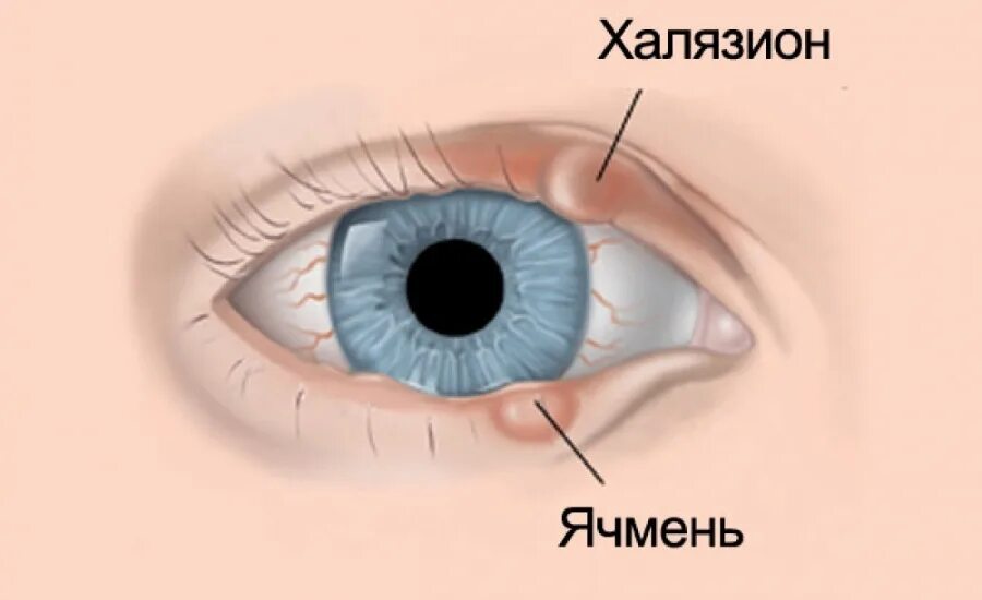 Почему вылазит глаз. Этапы развития ячменя на глазу.