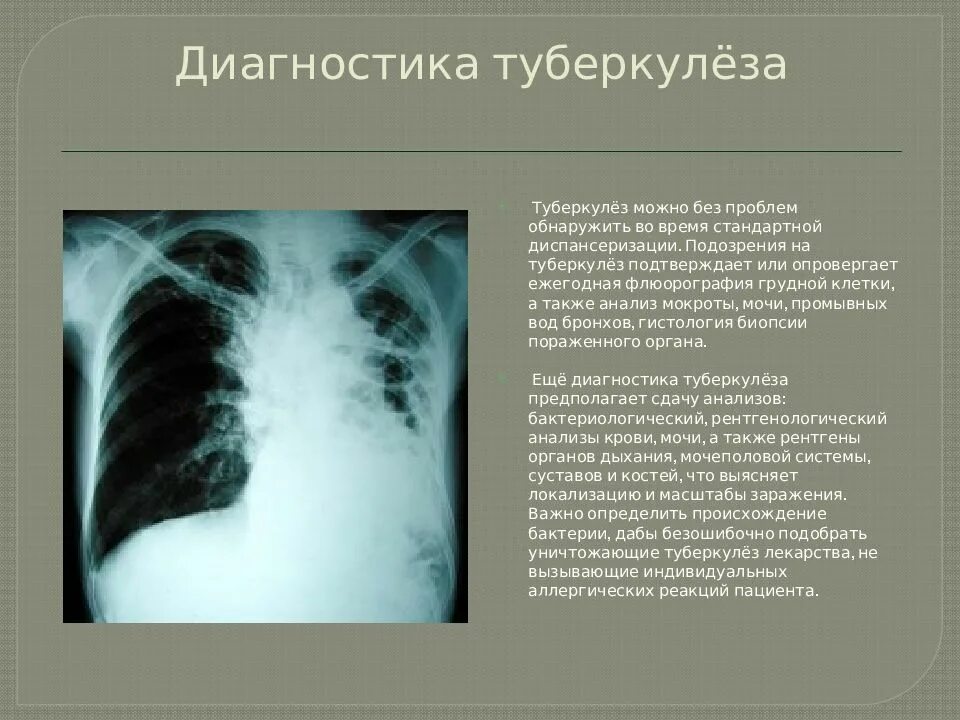 Туберкулез сколько лет. Диагноз туберкулез. диагностикатуберкулёза. выявление туберкулеза.