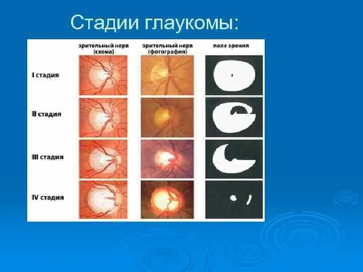 Врожденная глаукома классификация. Глаукома поля зрения по стадиям. Этапы развития глаукомы. Классификация первичной глаукомы.