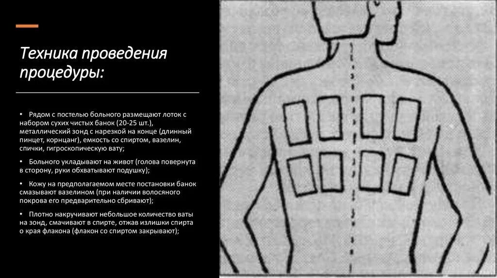 Можно ставить горчичники при сухом кашле. Схема постановки горчичников при кашле. Схема постановки горчичников при кашле у ребенка. Схема горчичники при пневмонии. Схема постановки горчичников при пневмонии.