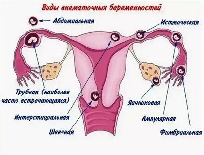 Месячные после внематочной беременности