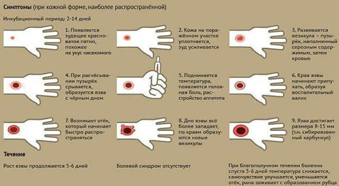 Болезненный безболезненный. Сибирская язва кожные проявления. Стадии развития кожной формы сибирской язвы. Кожные проявления при сибирской язве. Сибирская язва кожная форма у человека.