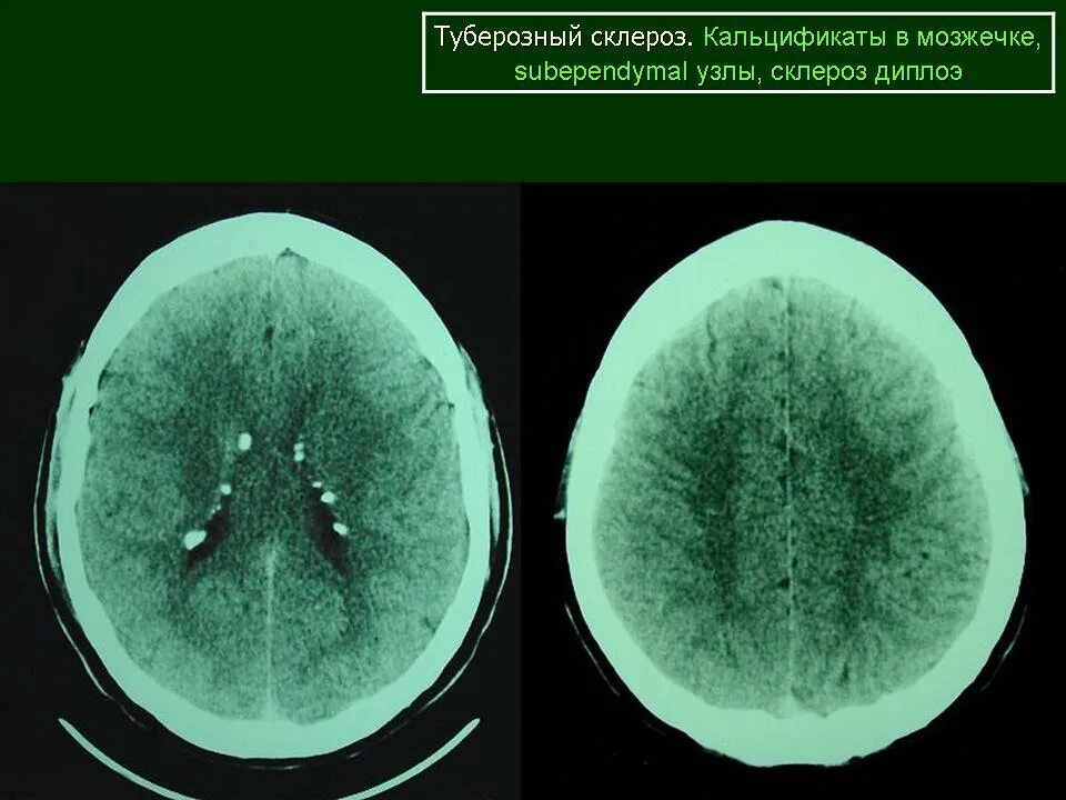 Туберкулезный склероз. Ангиофибромы туберозный склероз. факоматозы (туберозный склероз). туберозный склероз шагреневая бляшка. туберозный склероз бурневилля.
