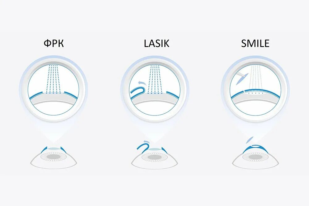 Лазерная коррекция зрения методом Femto-LASIK. RELEX smile лазерная коррекция зрения. Метод ФРК лазерная коррекция. LASIK лазерный кератомилез. Коррекция smile clinicaspectr ru