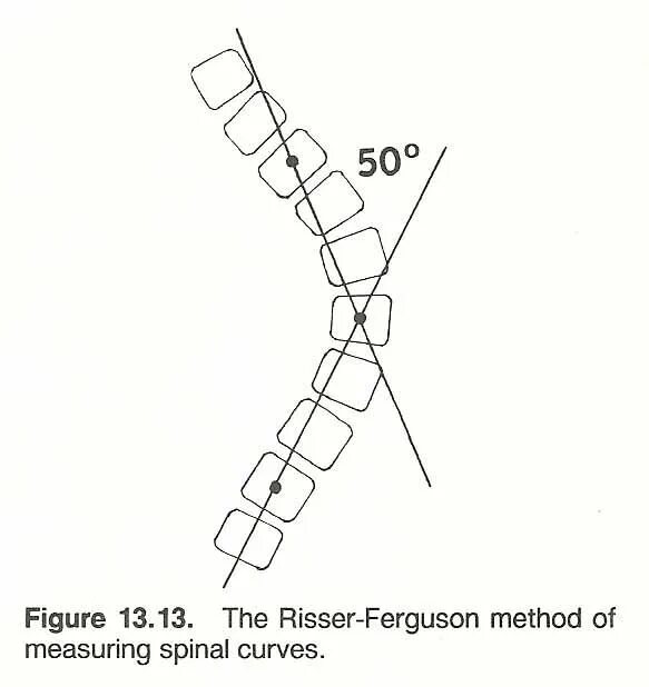 Метод Кобба сколиоз степени. Угол Кобба степени сколиоза. Метод Фергюсона риссера. Угол сколиоза метод Фергюсона. Угол кобба