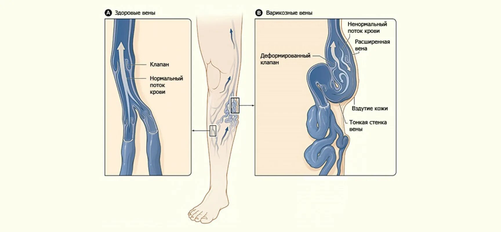 Что значат вены на ногах. Варикозное расширение вен (ВРВ) нижних конечностей. Классификация. Варикозное расширение вен НК. Варикозное заболевания расширение вен нижних конечностей. Варикозное расширение вен этиология и патогенез.