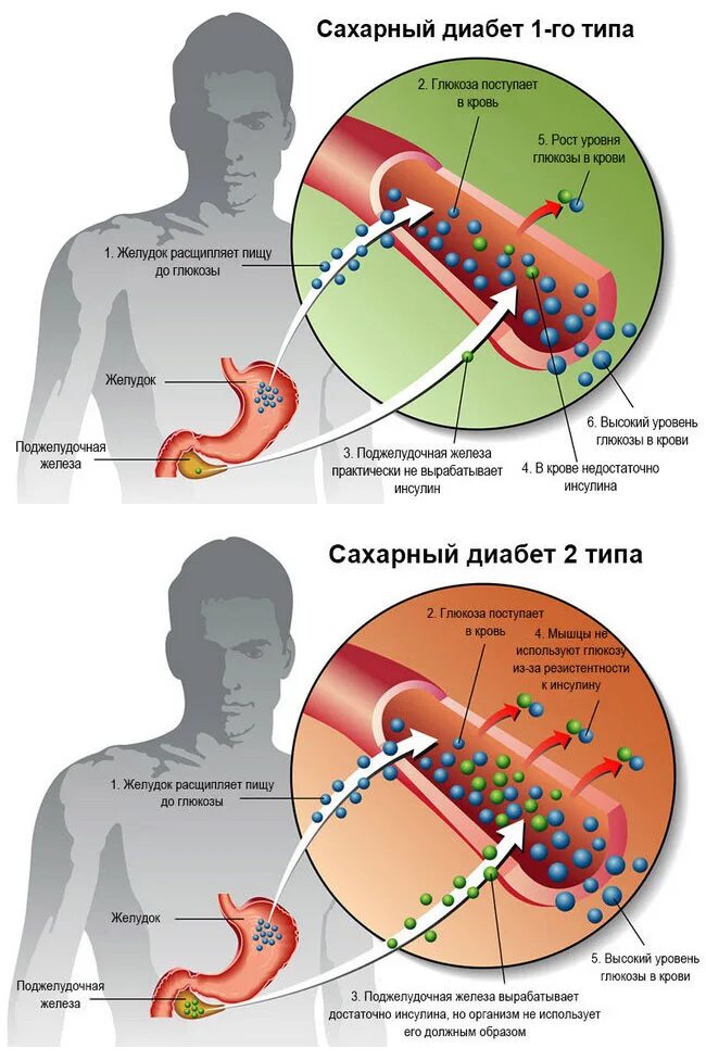 Сахарный диабет. Сахарный диабет 1 ти 2 типа. Диабет 1 типа. Больной сахарным диабетом 1 типа. Диабет зависимый сахарный