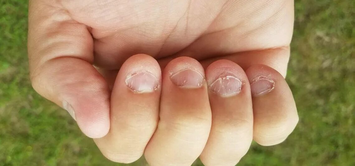 Почему кусаю пальцы. Короткие ногти обгрызанные.