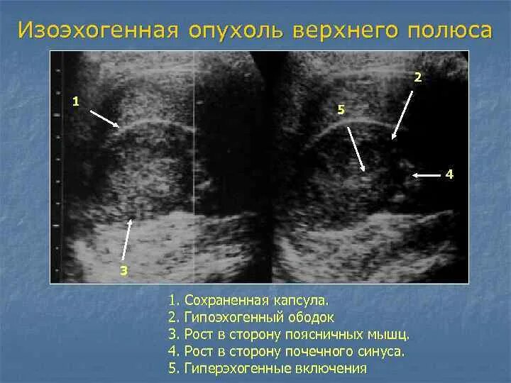 Гиперэхогенным округлым образованием. Изоэхогенное образование в почке на УЗИ что это такое. Изоэхогенное образование в печени на УЗИ. Изоэхогенное образование щитовидной железы УЗИ.