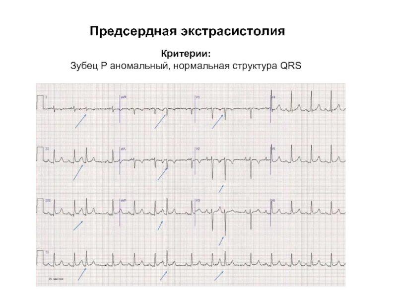 Нарушение ритма экстрасистолия мкб. Предсердные экстрасистолы на экг. критерии предсердной экстрасистолии. предсердная и желудочковая экстрасистолия. предсердия экстрасистолия критерии.