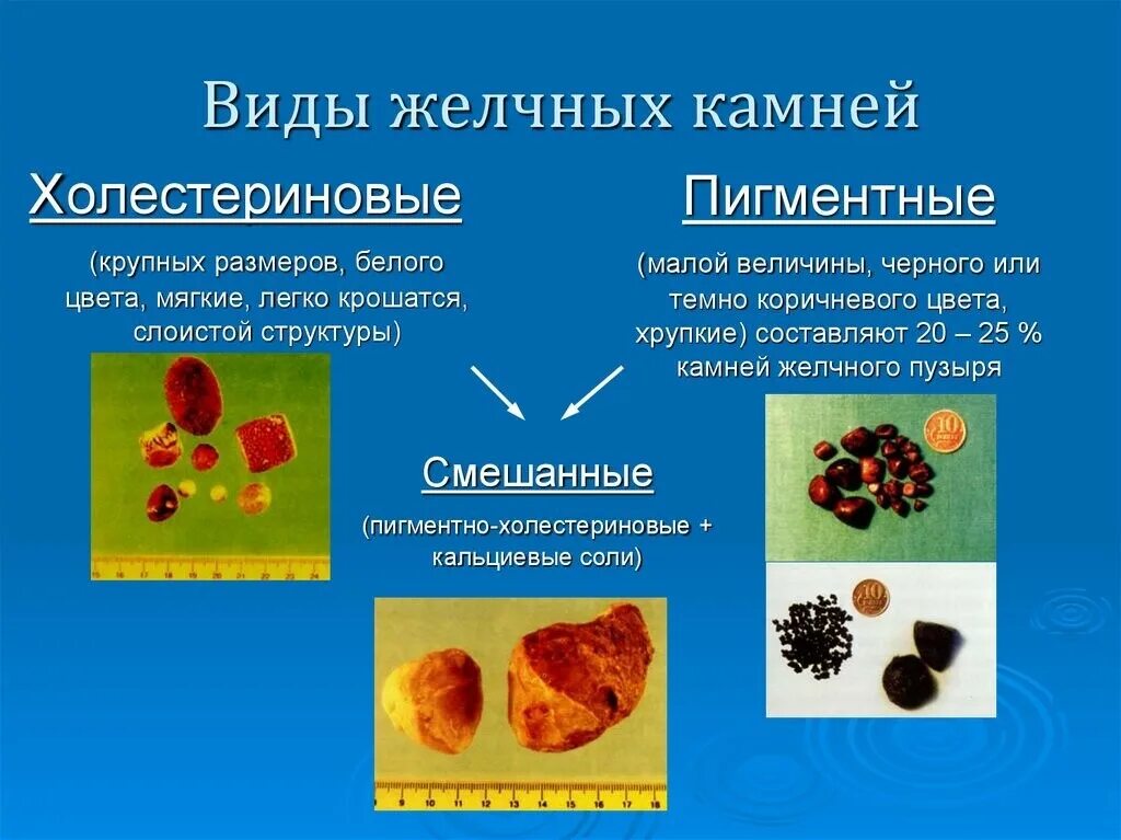 Классификация камней при ЖКБ. Желчнокаменная болезнь пигментные камни. Классификация камней желчного пузыря. Виды конкрементов при желчекаменной болезни.