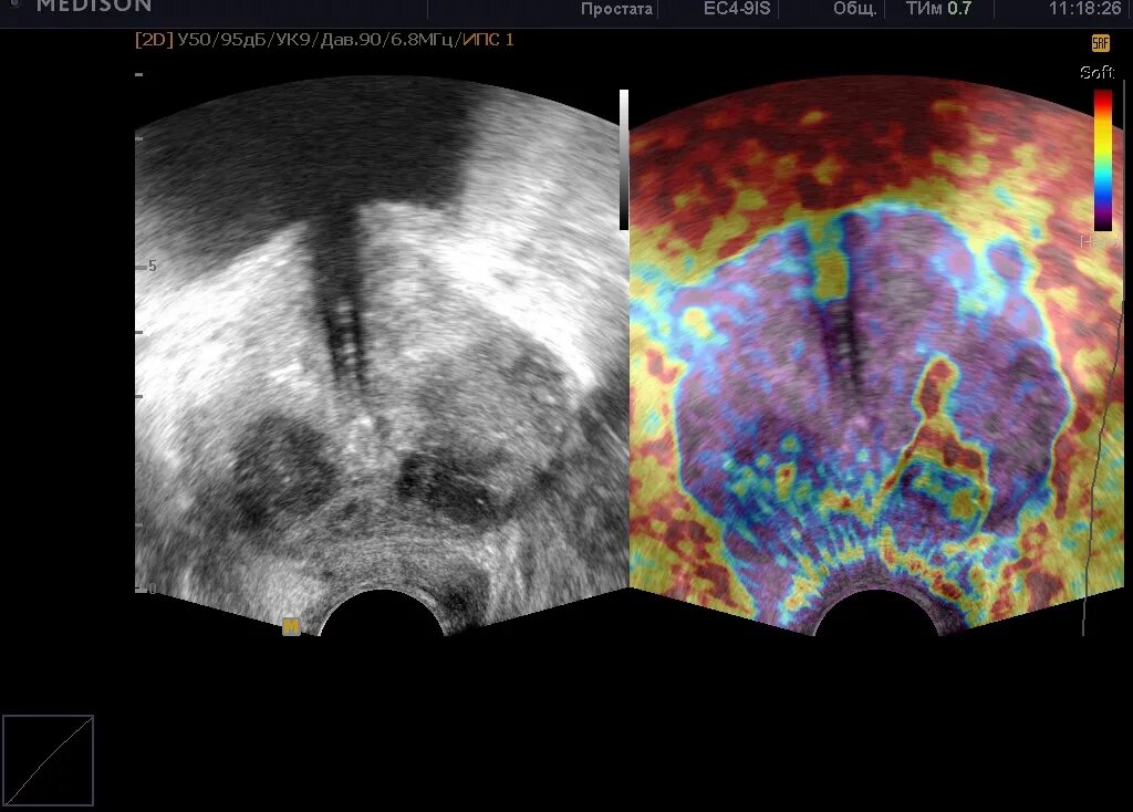 Абсцесс предстательной железы УЗИ. Трансректальное УЗИ простаты. УЗИ трузи предстательной железы. Трансректальное УЗИ абсцесса простаты.