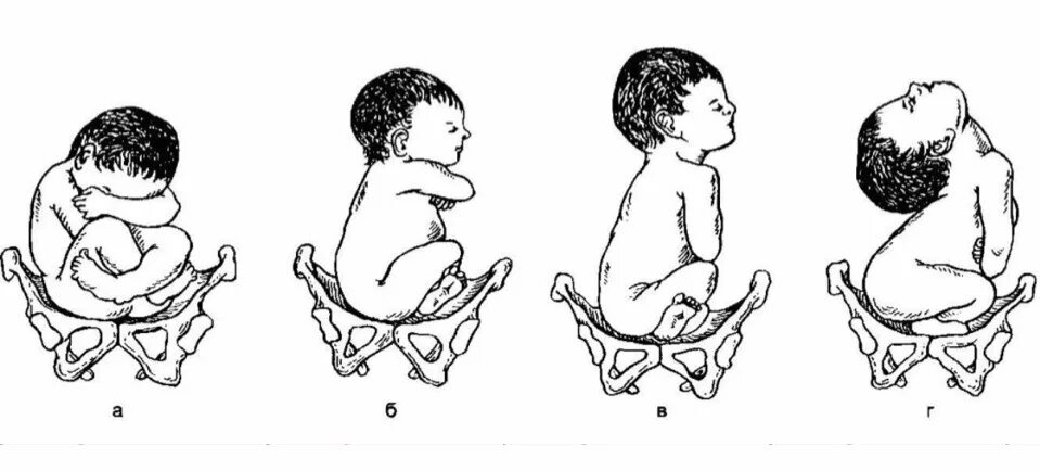 Смешанное положение. Продольное предлежание тазовое 2 позиция передний вид. Смешанное положение. Предлежание плода классификация. Тазовое предлежание плода.