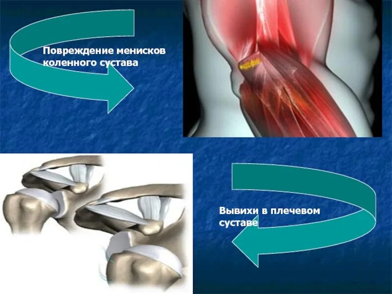 Повреждение мениска коленного сустава. Повреждение менисков коленного сустава травматология. Разрывы менисков коленного сустава. Повреждение мениска колена.