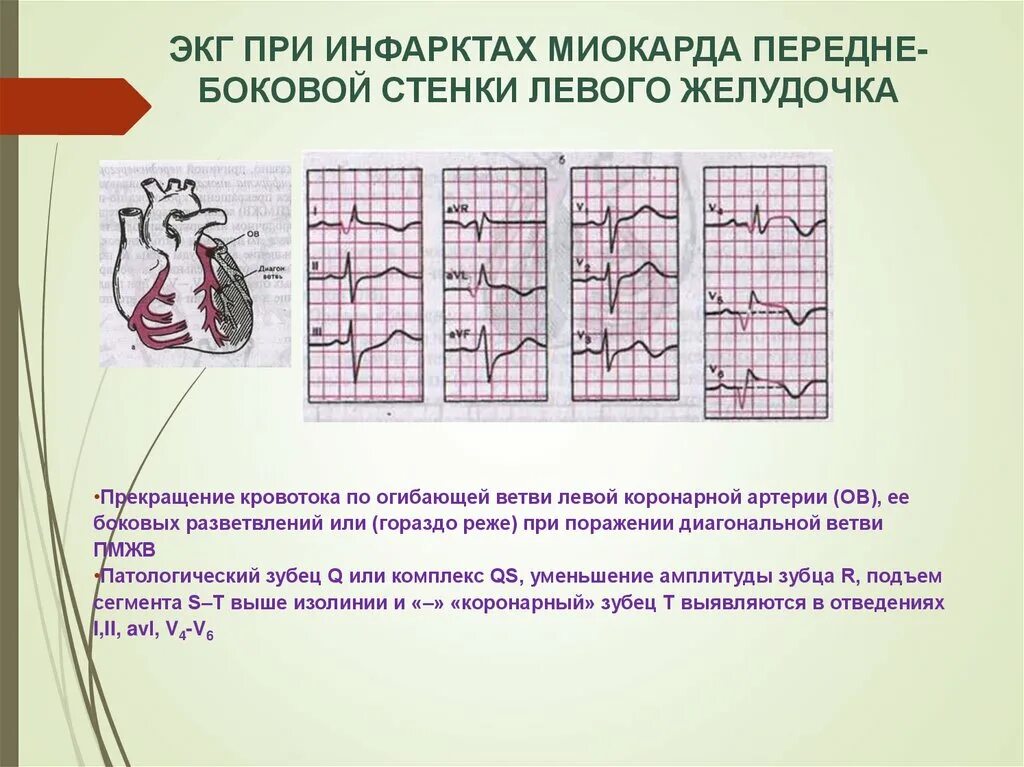 ЭКГ острый инфаркт миокарда передне боковой. Инфаркт миокарда переднебоковой стенки. Инфаркт миокарда передне-боковой стенки. ЭКГ инфаркт передней боковой стенки. Изменения боковых отделов