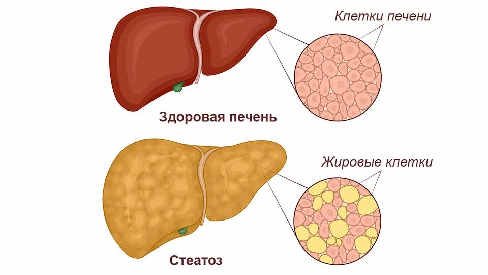 Чем опасна жировая печень. Жировой гепатоз (стеатоз) печени. Жировая дегенерация печени стеатоз печени. Жировая дистрофия печени (стеатоз печени). Неалкогольный жировой гепатоз печени.