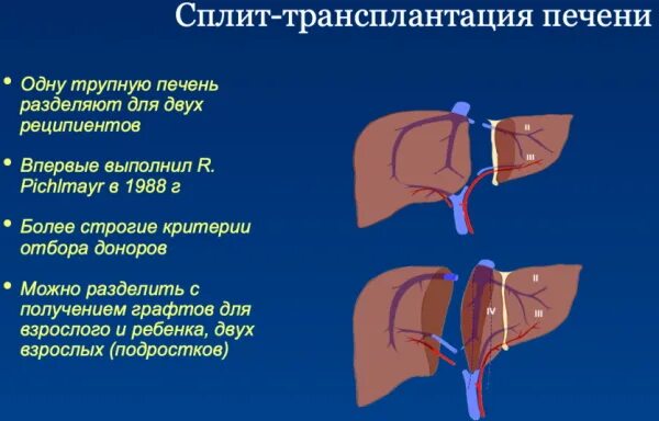 Трансплантация печени. Трансплантация печени презентация. Сплит трансплантация печени это. Миланские критерии трансплантации печени.