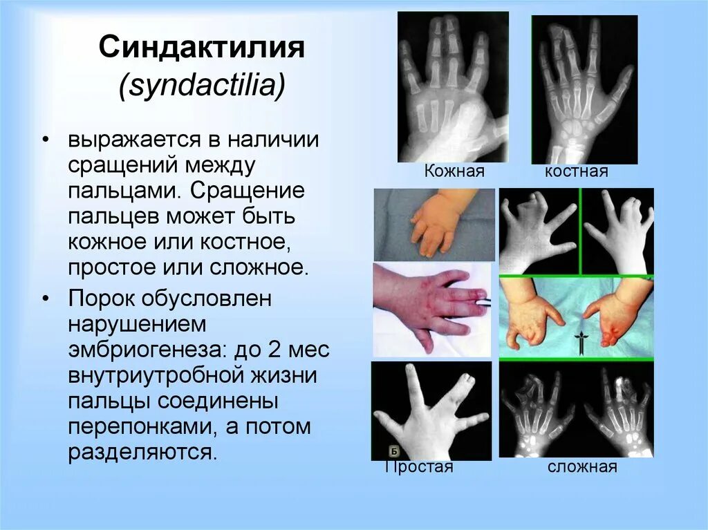 Имеет два развитых пальца. Костная форма синдактилии. Пороки развития кисти синдактилия. Синдактилия рентген описание. Симбрахидактилия левой кисти левой стопы.