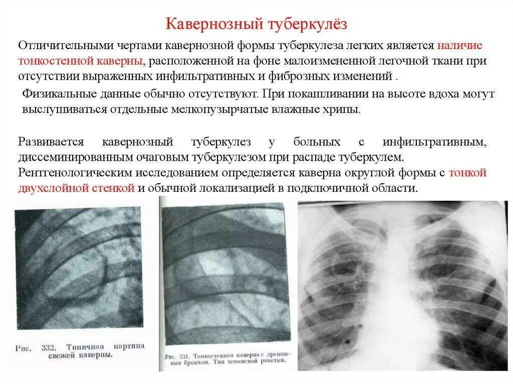 Кавернозная форма туберкулеза легких рентген. Фиброзно кавернозная форма туберкулеза рентген. Рентген фиброзно кавернозного туберкулеза синдром. Фибринозно-кавернозный туберкулёз рентген. Наличие очаговых изменений