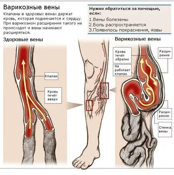 Варикозное расширение вен на ногах. Варикозное расширение нижних конечностей. Варикозное расширение вен (ВРВ) нижних конечностей. Вены ног клапаны