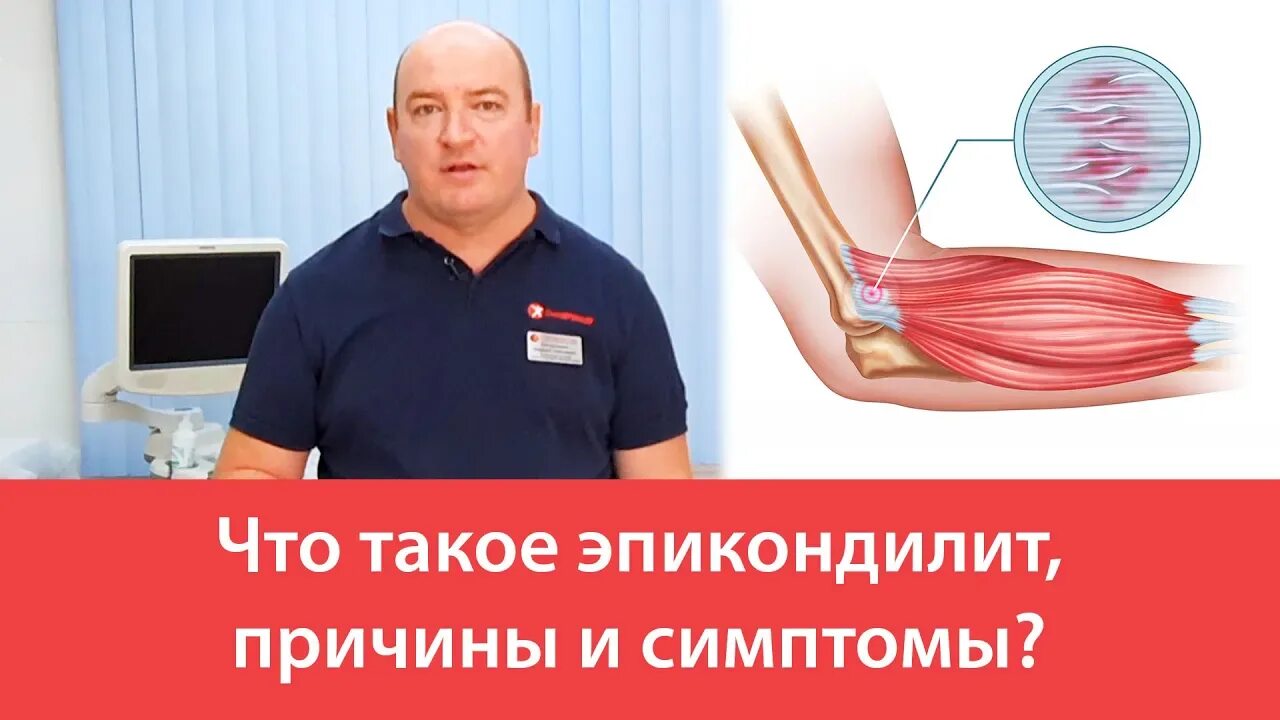 Эпикондилит клинические рекомендации. Медиальный эпикондилит. латеральный эпикондилит. эпикондилит локтевого сустава. латеральный эпикондилит локтя.