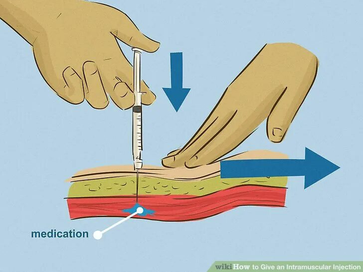 Как правильно колоть железо. Внутримышечная инъекция. Инъекция внутримышечно в ягодицу. Правильная постановка укола в ягодицу. Как сделать внутримышечный укол.