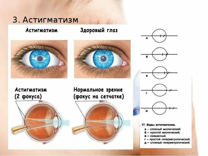 Зрение 6 10. Линзы для сложного миопического астигматизма. Сложный гиперметропический астигматизм у детей в 1 год. Линзы -2.25 и -2.5 астигматизм. Сложный миопический астигматизм степени.