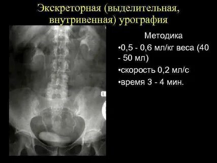 Экскреторная урография