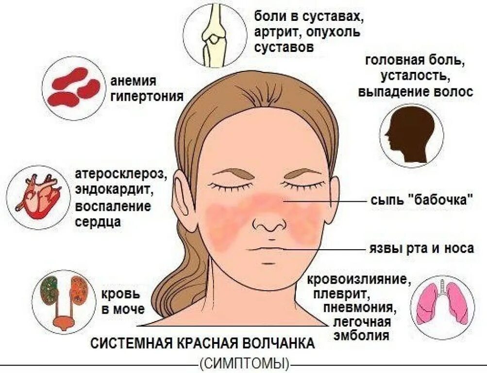Красная системная волчанка признаки симптомы. Системная красная волчанка формы. Волчанка системная причина заболевания. Красная системная волчанка признаки симптомы. Хроническая системная красная волчанка.