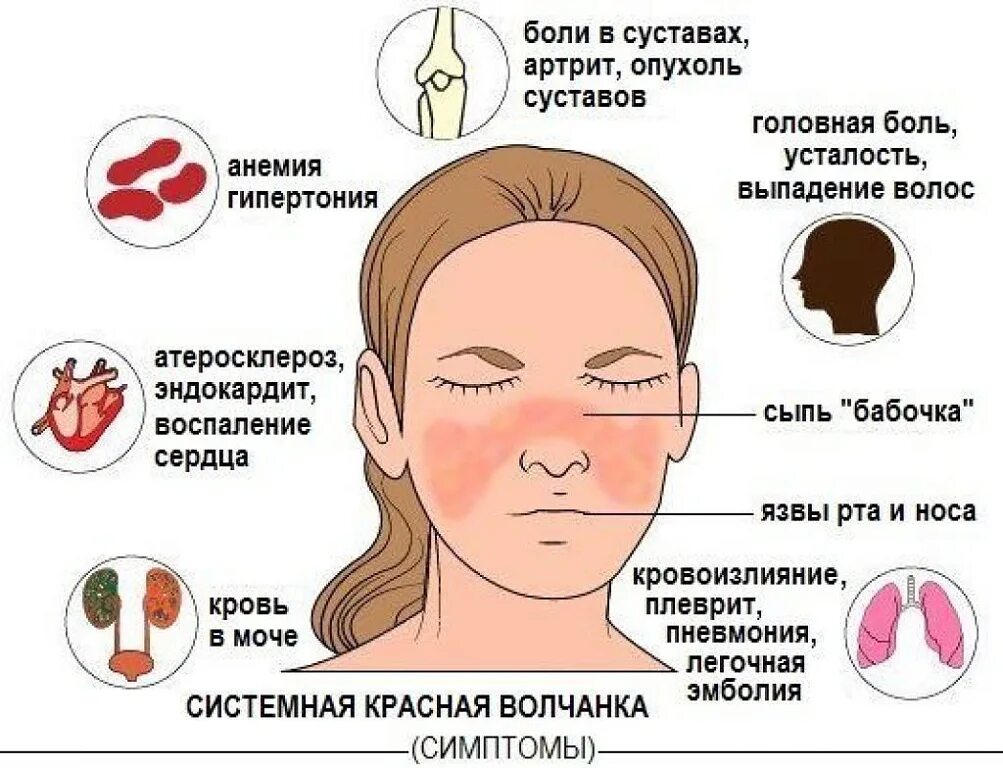 Красный осложнение. Системная красная волчанка диагностика. Системная красная волчанка клинические проявления. Системная красная волчанка дискоидная сыпь. Системная красная волчанка диагностика анализы.