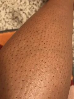 Гусиная кожа на ногах