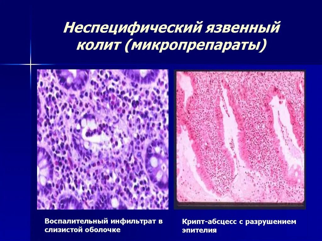 Хронический язвенный колит микропрепарат. Неспецифический язвенный колит микропрепарат. Хронический язвенный колит макропрепарат. Неспецифический язвенный колит макропрепарат.