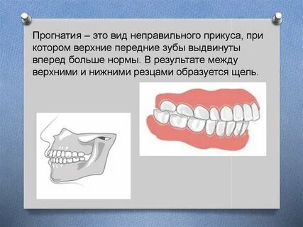 Прикус челюсть вперед