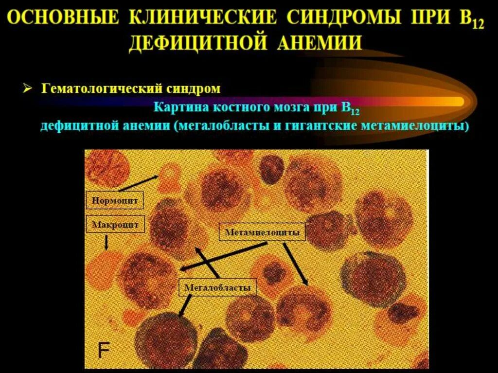 В12 дефицитная анемия симптомы. В12 дефицитная анемия степени тяжести. картина костного мозга при в12 дефицитной анемии. язык при б12 дефицитной анемии. клиническая картина в12 дефицитной анемии.
