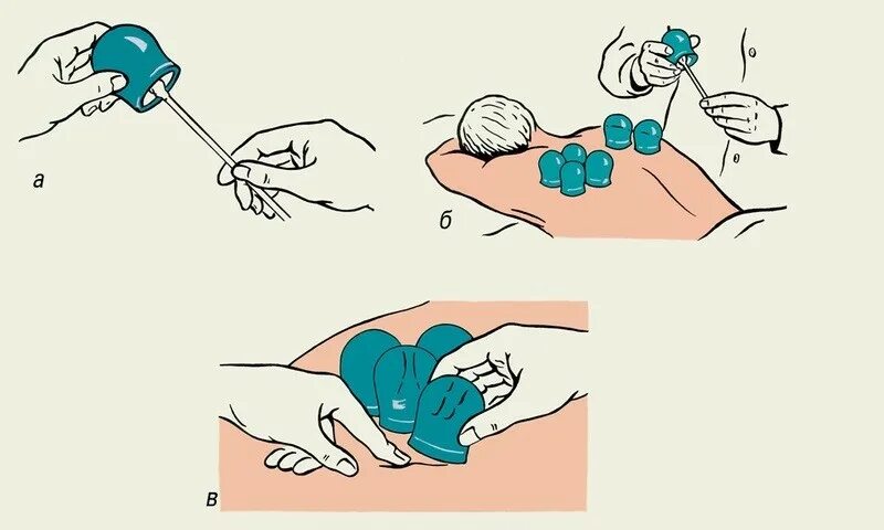 Как часто можно делать банки. Схема постановки медицинских банок при бронхите. Постановка банок при бронхите алгоритм. Техника постановки медицинских банок. Постановка банок при бронхите.