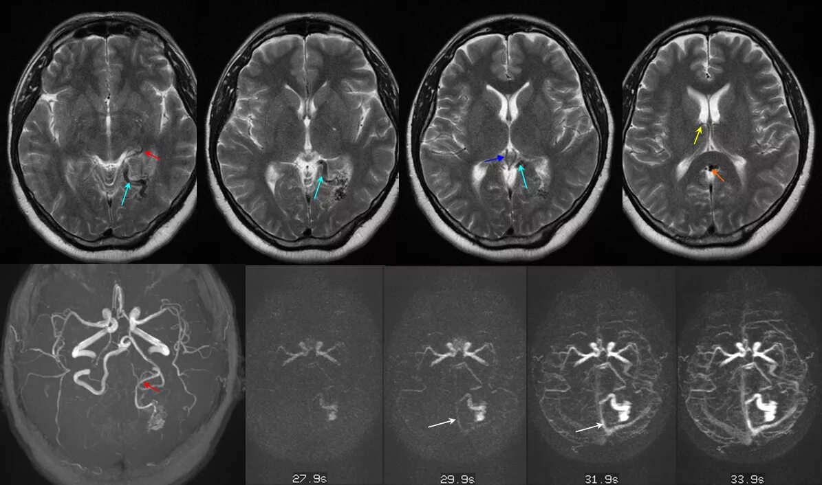 Ангиома мозга лечение. Венозная ангиома головного мозга мрт.