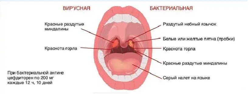 Асимметрия зева