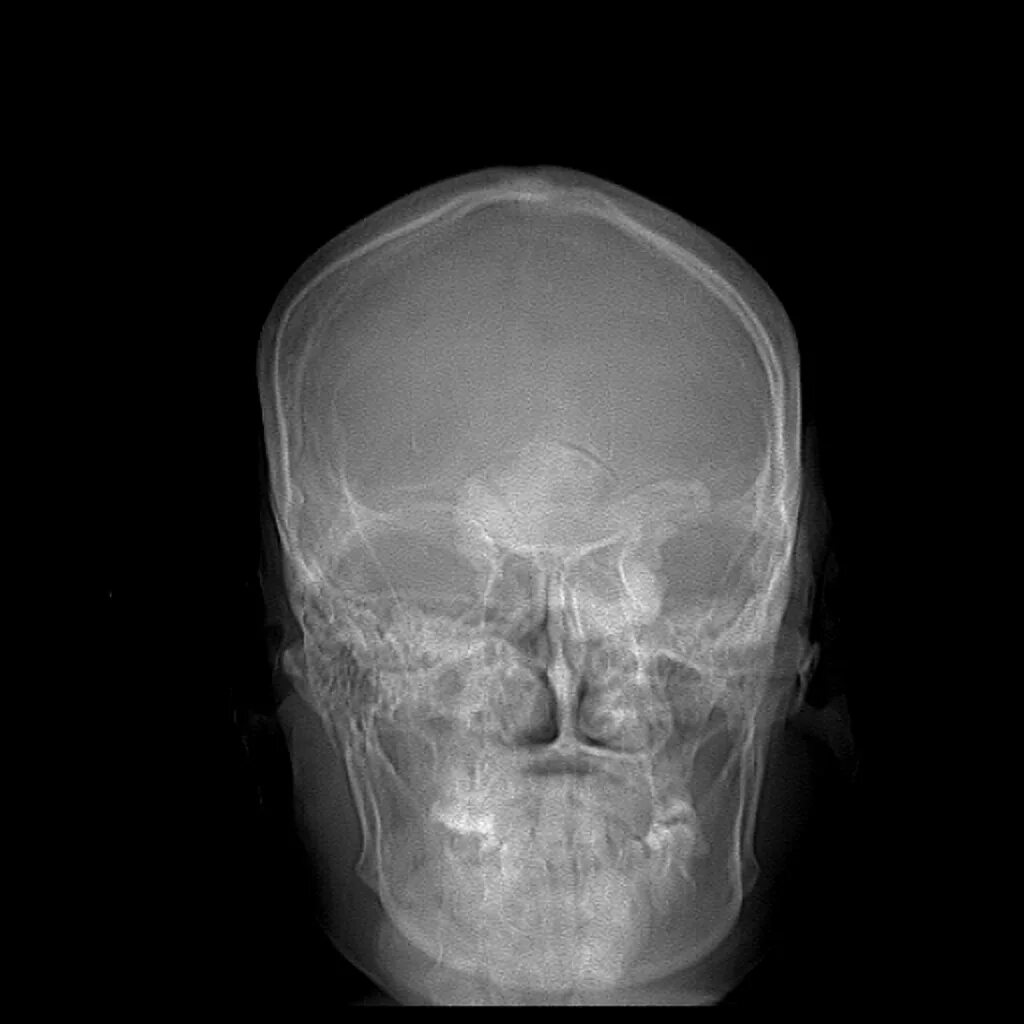 Кости черепа рентген. Остеома кости черепа на кт. Остеоид остеома костей черепа. Остеоид остеома костей черепа на кт. Остеома лобной кости рентген.