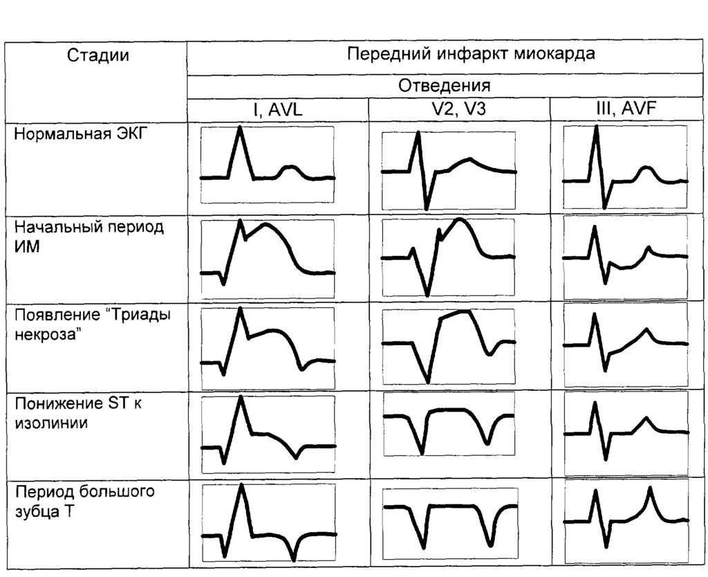 Инфаркт миокарда 2025. Экг при инфаркте миокарда по стадиям. экг критерии острой стадии инфаркта миокарда. острый период инфаркта миокарда на экг. инфаркт миокарда на экг по стадиям.