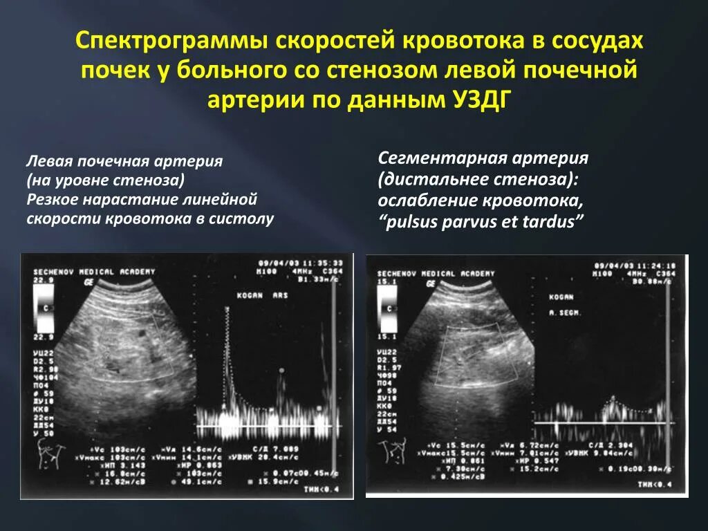 УЗИ сосудов печени допплер протокол. Допплер почечных артерий норма. Допплер сосудов почек протокол УЗИ. УЗИ почечных артерий протокол. Индекс резистентности артерий