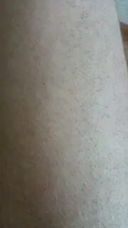 Гусиная кожа у ребенка